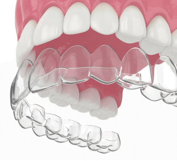 Invisalign ¿Realmente Funciona? Ortodoncia Invisible - Invisalign en Ciudad  de México